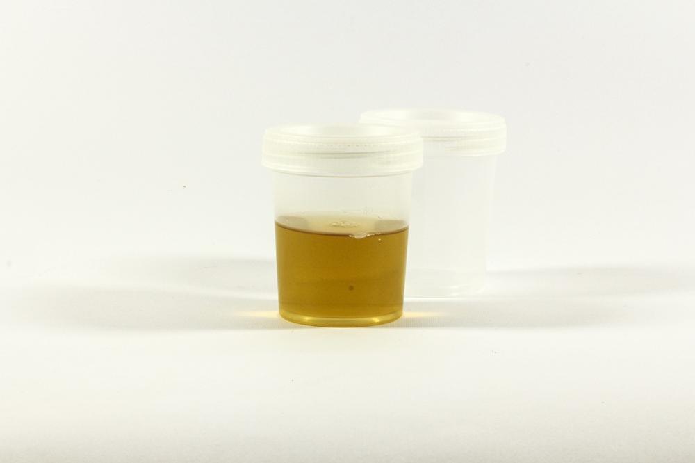 urine collection-fdc5cfdd39bc4c5a9aa5824123b3bdc0.jpg urine collection
